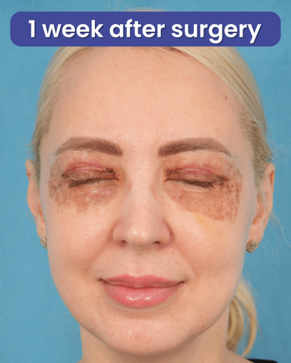 Upper Blepharoplasty Before & After Patient #3120