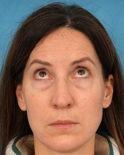 Lower Blepharoplasty Before & After Patient #3153