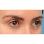 Upper Blepharoplasty Before & After Patient #3165