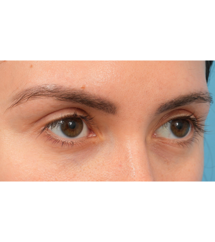 Upper Blepharoplasty Before & After Patient #3165
