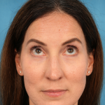 Lower Blepharoplasty Before & After Patient #3153