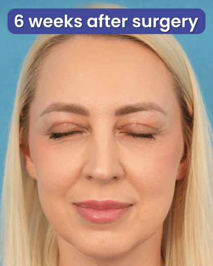 Upper Blepharoplasty Before & After Patient #3120