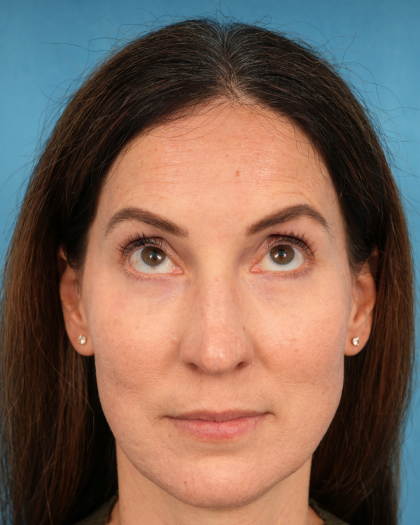 Lower Blepharoplasty Before & After Patient #3153