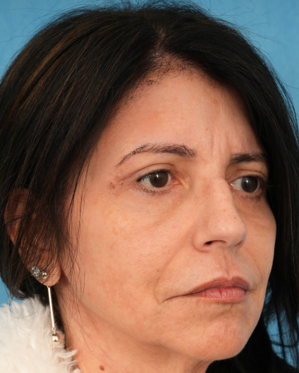 Morpheus8 Before & After Patient #3182