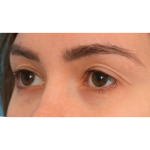 Upper Blepharoplasty Before & After Patient #3165