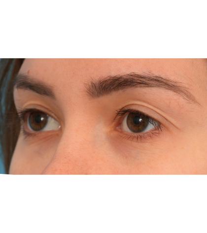 Upper Blepharoplasty Before & After Patient #3165