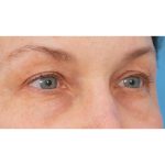Quad Blepharoplasty Before & After Patient #3197