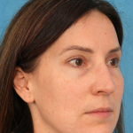 Lower Blepharoplasty Before & After Patient #3153