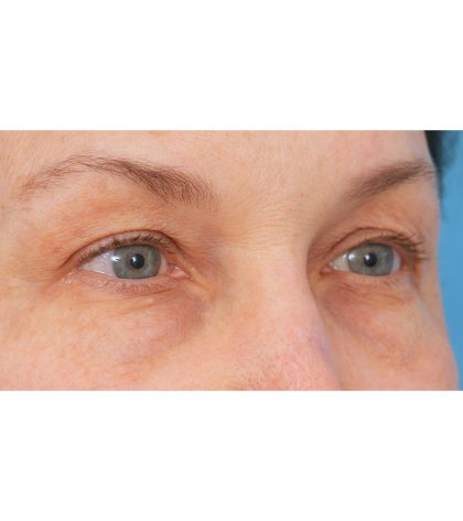 Quad Blepharoplasty Before & After Patient #3197