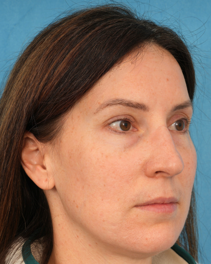 Lower Blepharoplasty Before & After Patient #3153