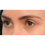 Upper Blepharoplasty Before & After Patient #3165