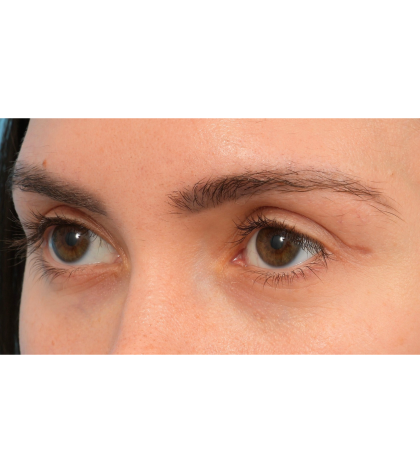 Upper Blepharoplasty Before & After Patient #3165