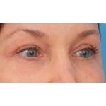 Quad Blepharoplasty Before & After Patient #3197