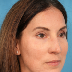 Lower Blepharoplasty Before & After Patient #3153