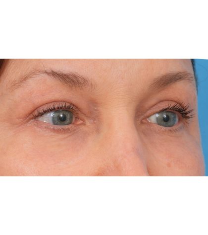Quad Blepharoplasty Before & After Patient #3197