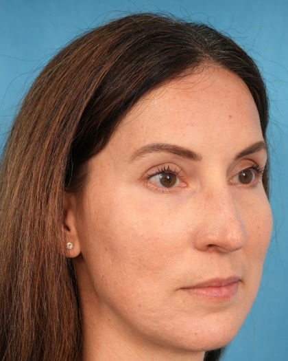 Lower Blepharoplasty Before & After Patient #3153