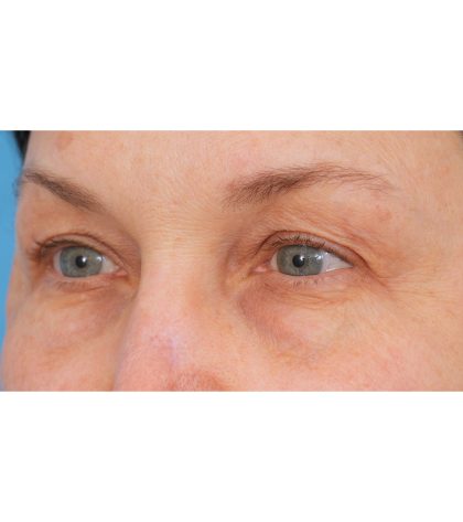 Quad Blepharoplasty Before & After Patient #3197