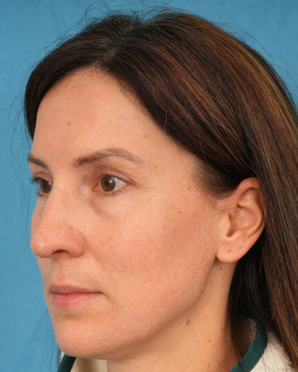 Lower Blepharoplasty Before & After Patient #3153