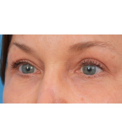 Quad Blepharoplasty Before & After Patient #3197