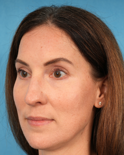 Lower Blepharoplasty Before & After Patient #3153