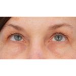 Quad Blepharoplasty Before & After Patient #3197