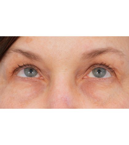 Quad Blepharoplasty Before & After Patient #3197