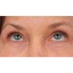 Quad Blepharoplasty Before & After Patient #3197