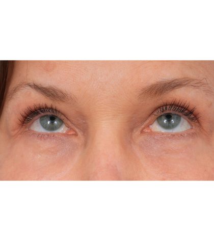 Quad Blepharoplasty Before & After Patient #3197