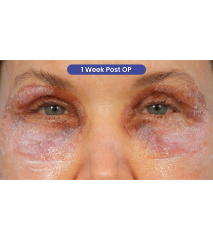 Quad Blepharoplasty Before & After Patient #3197
