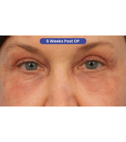Quad Blepharoplasty Before & After Patient #3197