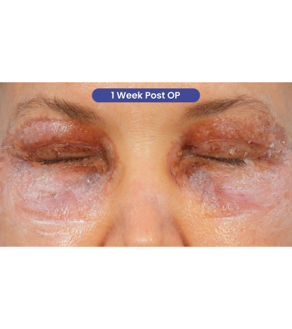 Quad Blepharoplasty Before & After Patient #3197
