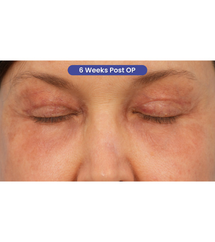 Quad Blepharoplasty Before & After Patient #3197