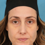 Lower Blepharoplasty Before & After Patient #3263
