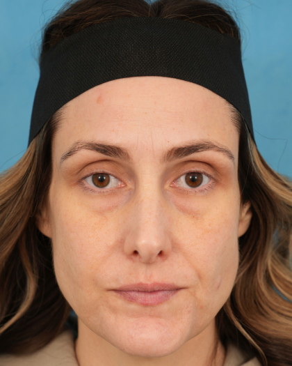 Lower Blepharoplasty Before & After Patient #3263