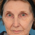 CO2 Laser Resurfacing Before & After Patient #3220