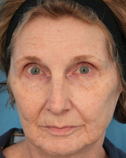 CO2 Laser Resurfacing Before & After Patient #3220