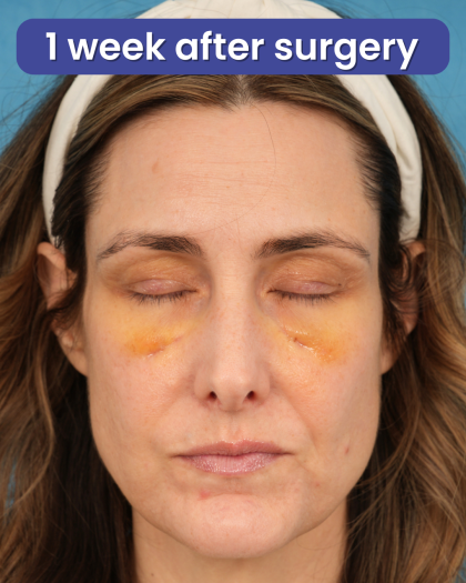 Lower Blepharoplasty Before & After Patient #3263