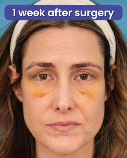 Lower Blepharoplasty Before & After Patient #3263
