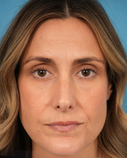 Lower Blepharoplasty Before & After Patient #3263