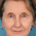 CO2 Laser Resurfacing Before & After Patient #3220
