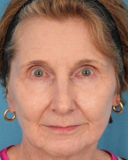CO2 Laser Resurfacing Before & After Patient #3220