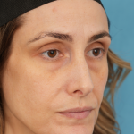 Lower Blepharoplasty Before & After Patient #3263
