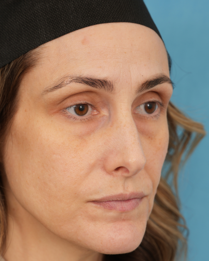 Lower Blepharoplasty Before & After Patient #3263