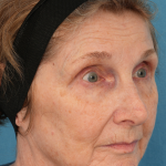 CO2 Laser Resurfacing Before & After Patient #3220