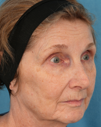 CO2 Laser Resurfacing Before & After Patient #3220