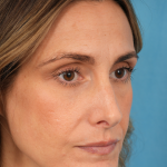Lower Blepharoplasty Before & After Patient #3263