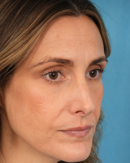 Lower Blepharoplasty Before & After Patient #3263
