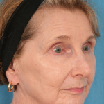 CO2 Laser Resurfacing Before & After Patient #3220