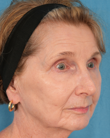 CO2 Laser Resurfacing Before & After Patient #3220