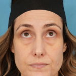 Lower Blepharoplasty Before & After Patient #3263